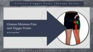 Gluteus Minimus Pain and Trigger Points [upl. by Doscher]