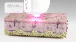 Schmerzlose Laser Haarentfernung bei firstmedica in Hamburg dank Motif LHR [upl. by Amitak723]