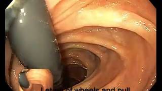 Right Colon Retroflexion [upl. by Ahsem]