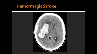 Atherosclerosis Hemorrhagic Stroke Ischemic Stroke amp Transient Ischemic Attack TIA [upl. by Noiemad]