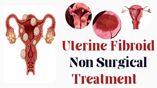 Treating Uterine Fibroid without Surgery  Embolization  uterinefibroidtreatment fibroidsurgery [upl. by Bounds]