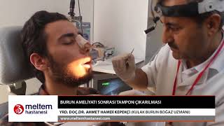 Burun Ameliyatı Sonrası Tampon ÇıkarılmasıYrd Doc Dr Ahmet Hamdi Kepekçi [upl. by Radack]