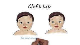 Cleft lip and Cleft Palate Surgery V1 [upl. by Sabu]