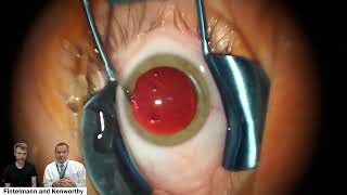 Bilateral Implantable Collamer Lens ICL Insertion [upl. by Trahurn]