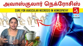 ரத்தஓட்டம் தடைபடுவதால் வரும் Avascular necrosis loss of blood supply to bone Avascular necrosis AVN [upl. by Atinit195]