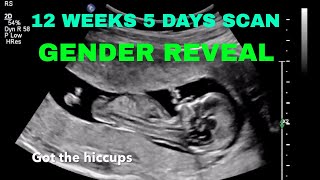 12 weeks 5 days Ultrasound GENDER REVEAL [upl. by Cheney36]