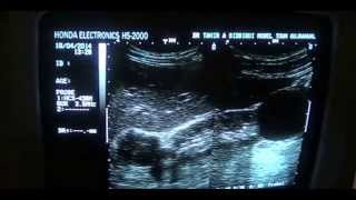 cystic vs solid FOCAL MASS of KIDNEY [upl. by Latricia198]