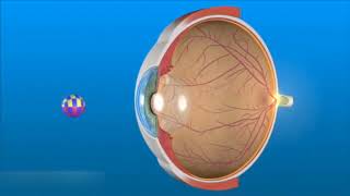 Chirurgie réfractive  Opération laser des yeux  Myopie hypermétropie astigmatisme amp presbytie [upl. by Euqor913]