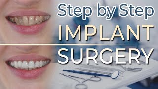 Dental Implant Surgery  Step by Step 27 Extraction and Ridge Preservation [upl. by Enihpesoj]