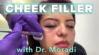 Watch This Patient Get Cheek Filler Before amp After Restylane Contour [upl. by Yttak]