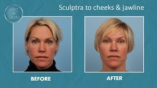 Sculptra filler for cheeks and jawline [upl. by Veta]