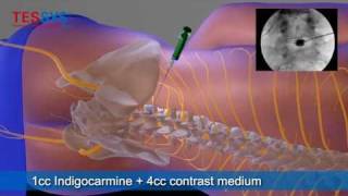 Treatment of herniated disc with TESSYS method lateral  BandscheibenOP mit TESSYSMethode lateral [upl. by Yttisahc]