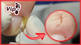 PODOLOGIA EM UNHA ENCRAVADA OVERGROWN INFECTED INGROWN TOENAIL REMOVAL [upl. by Okire]