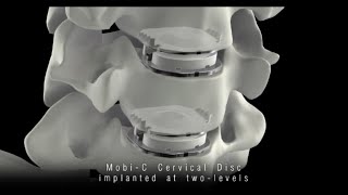 MobiC® Cervical Disc [upl. by Nahseez318]