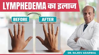 How to Manage Lymphedema Effective Treatment Options हिंदी में  Sentinel Lymph Node Biopsy [upl. by Ambrosine]