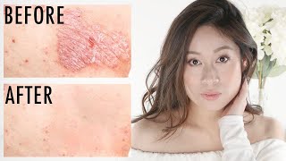 Psoriasis  How To Get Rid of Itchy Scaly Skin  Vivienne Fung [upl. by Sinoda]