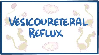 Vesicoureteral reflux  causes symptoms diagnosis treatment pathology [upl. by High]