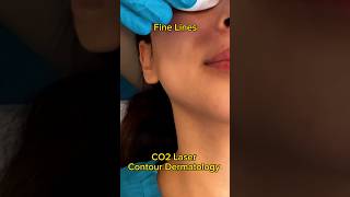 CO2 Laser Changed My Skin😱 acne acnescars beauty [upl. by Sura]