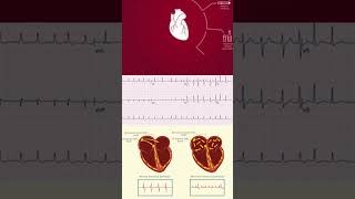 Learn about Fibrillation Management Prevention arrhythmia management cardio [upl. by Iolanthe925]