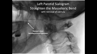 sialogram straighten stensens duct around masseter 11152021 [upl. by Dodwell]