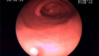 ENDOSCOPIA GASTRITIS HELICOBACTER EIC [upl. by Evelc221]