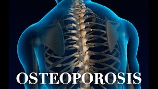 Osteoporosis in Thalassemia Early Symptoms Causes Treatments Prevention and More [upl. by Enaoj]