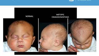 Neurosurgery Medical Student Primer  Craniosynostosis [upl. by Rebmit]