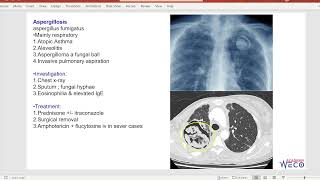 Medicine Infectious mononucleosis amp systemic fungal infections [upl. by Aivekal]