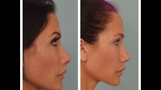 UPDATED Rhinoplasty Advice From Patient Nose Job Questions [upl. by Alasdair]