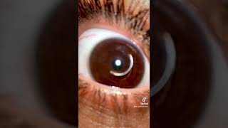 Eye drop Trend TikTok on Keratoconus [upl. by Gemini]