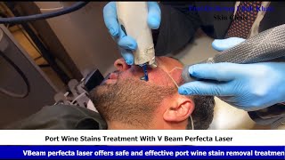 V Beam Wonders Your Solution to Port Wine Stain Perfection portwinestain lasertherapy [upl. by Schlesinger591]