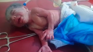 New born very premature baby camein gasping condition take action thanks God baby save after proces😥 [upl. by Penni]