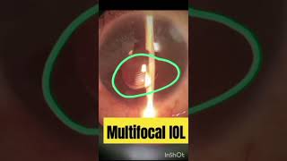 Multifocal IOL  iol eyelens eyediseases [upl. by Tiga485]