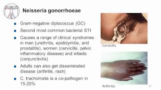 Syphilis Urethritis and Cervicitis [upl. by Aneelak]