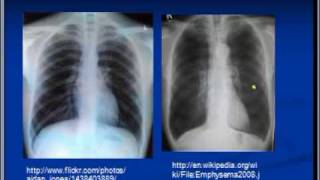 Chest xray interpretation COPD and Emphysema [upl. by Eiramlatsyrc115]