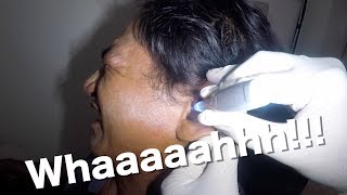 Mans Hard Clogged Earwax Finally Removed by Ear Suctioning [upl. by Sonny]