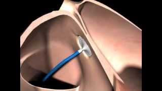 AMPLATZER® Septal Occluder [upl. by Nilrem]