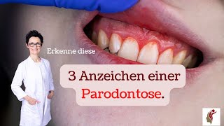 3 Anzeichen für Parodontose [upl. by Erdnad]