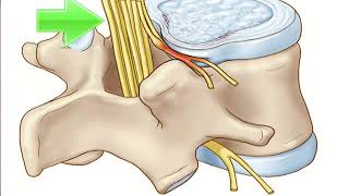 Cervical spondylosis disease treatment in homeopathycervical spondylosis without myelopathy [upl. by Marte6]