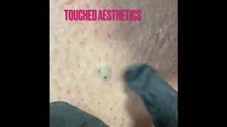 Episode 2 ingrown hair extractions [upl. by Ahsetel690]