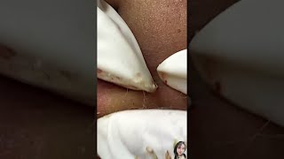 Big Cystic Acne Blackheads Extraction Blackheads amp Milia Whiteheads Removal Pimple Popping shorts [upl. by Aglo610]