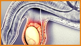 Hydrocele vs Varicocele vs Torsion vs Epididymitis vs Tumor [upl. by Hayalat]