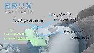 Why Choose Brux Night Guard for Teeth Grinding and Clenching [upl. by Ahsaekal113]