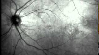 Eye Floaters Video [upl. by Ybrik]