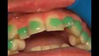 Gluing dental Braces [upl. by Nail]