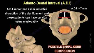 Rheumatoid Arthritis of the cervical spine  Everything You Need To Know  Dr Nabil Ebraheim [upl. by Latvina456]