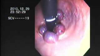 haemorrhoid banding BY DR NASEEM GHOURI [upl. by Acenes]