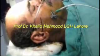 RFR for Trigeminal Neuralgia pain by Prof Dr Khalid Mahmood surgimed Hospital Lahore Pakistan [upl. by Hendrickson329]