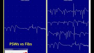 Positive sharp waves and fibrillations PSW PSWs Fibs [upl. by Assyn564]