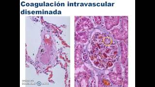 COAGULACIÓN INTRAVASCULAR DISEMINADA CID [upl. by Leahcim]